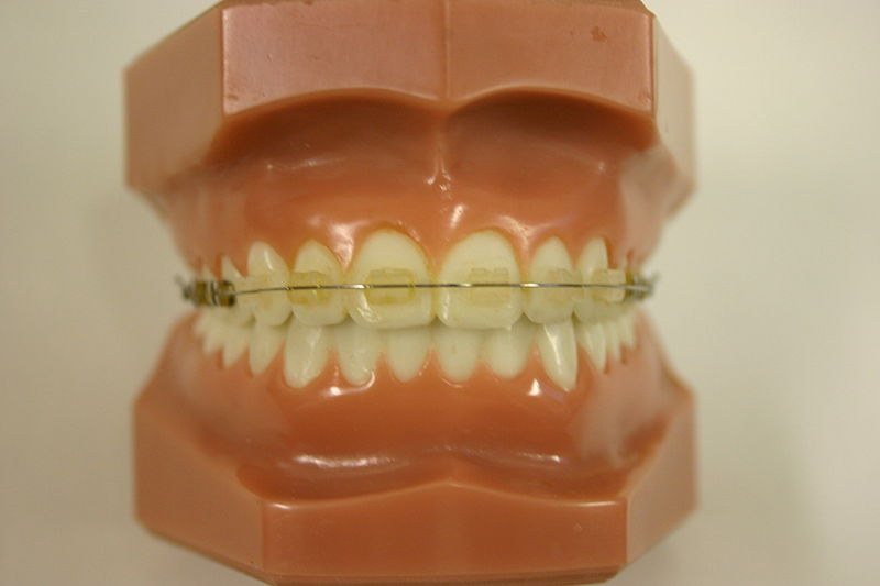Transparent ceramic orthodontic bracket