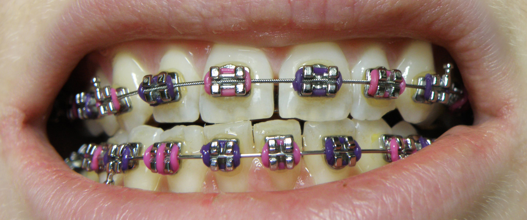 Traditional metal dental braces on upper and lower teeth