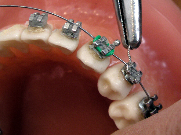 Close-up of orthodontic brackets and archwire
